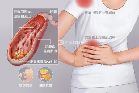 消化内科急性胆囊炎的典型症状是什么？疼痛位置很重要