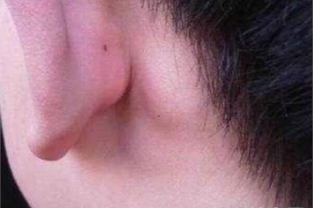 耳朵后面硬疙瘩，是哪种皮肤病？如何去皮肤性病科就诊？