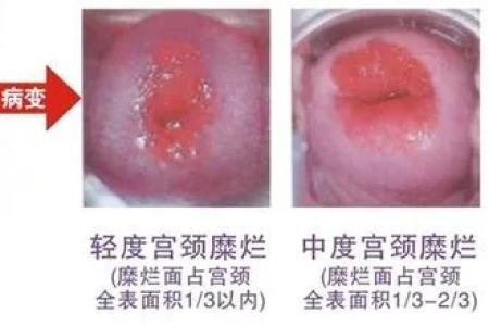 女性宫颈糜烂是怎么引起的？妇产科专家详细分析