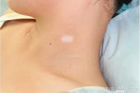 皮肤性病科权威解读：白癜风非对称长是假象吗？