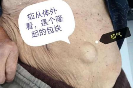 普外科医生讲解：宝宝脐疝的诊疗及护理要点