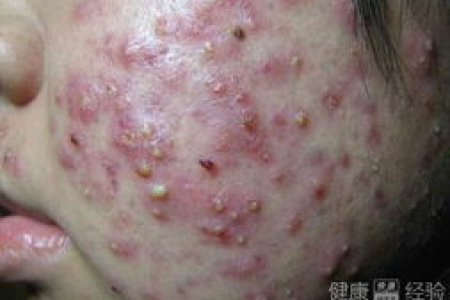 鼻子长痘又红又肿，皮肤性病科教你快速消除痘痘