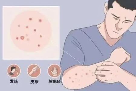 疱疹潜伏期男性生殖感染多久才出现症状？如何预防？
