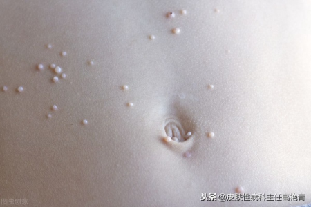 皮肤性病科传染性软疣如何治疗才能彻底根除复发？