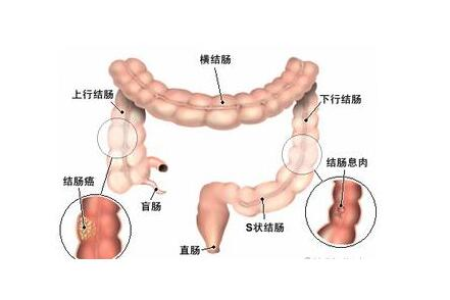 女性消化内科疾病：左下腹隐隐作痛的常见原因及应对方法