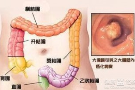 肠癌病人饮食禁忌及推荐：肿瘤科专家权威解读