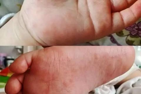 手足口病厉害吗？孩子得手足口病要花多少钱？