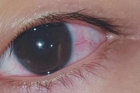 隐形眼镜戴久了眼睛红血丝，是什么原因？