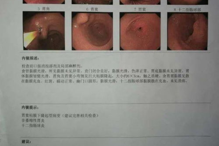 胃镜检查前需要做什么准备？消化内科医生详细解答