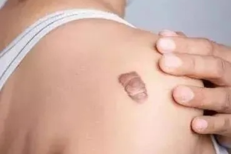 皮肤性病科治疗烫伤疤痕疙瘩，如何才能彻底消除？