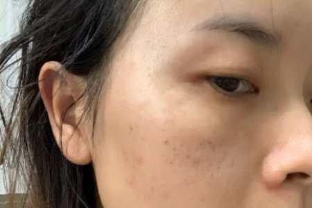 想做激光去斑？整形美容后多久恢复正常肤色？