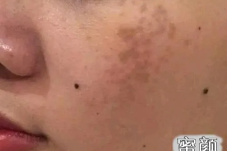 皮肤性病科：如何彻底去除恼人的蝴蝶斑？