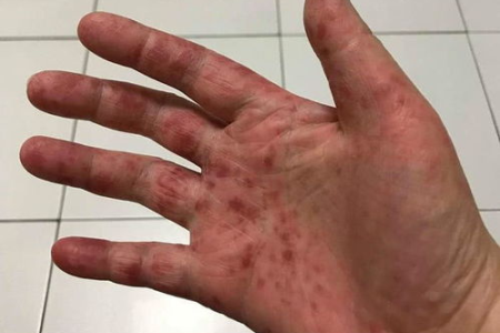 大人也会得手足口病吗？有哪些症状可以判断成人是否患病？