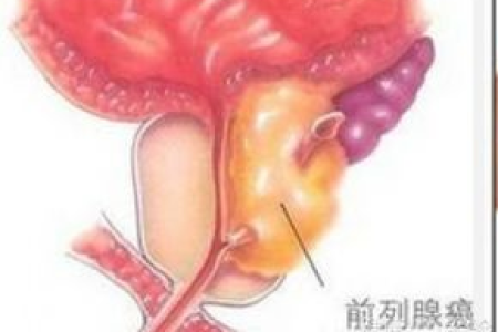 百度百科：肿瘤科前列腺癌TNM分期标准