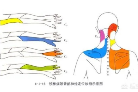 颈椎增生压迫神经引起手臂麻木疼痛，有哪些治疗方法？