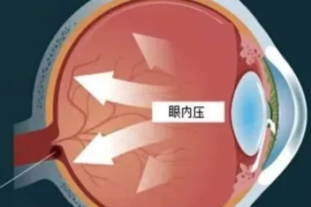 如何判断眼压是否过高？有哪些症状和潜在危害？
