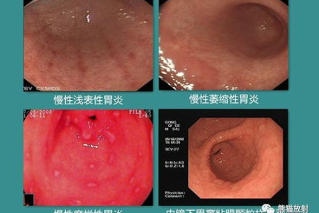消化内科胃溃疡吃什么好？助你恢复健康的饮食指南