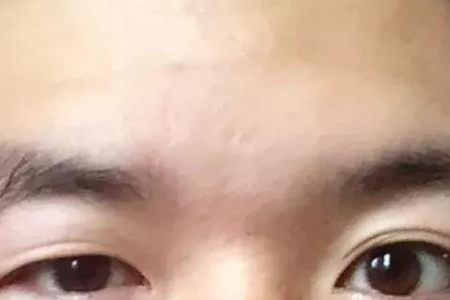 整形美容：父母一单一双，宝宝双眼皮几率有多大？