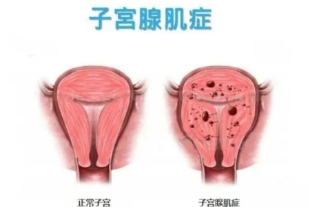 腺肌症怎么治？治疗腺肌症的最佳方法是什么？