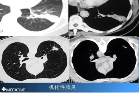 结核性胸膜炎的早期症状是什么？心胸外科如何鉴别诊断？