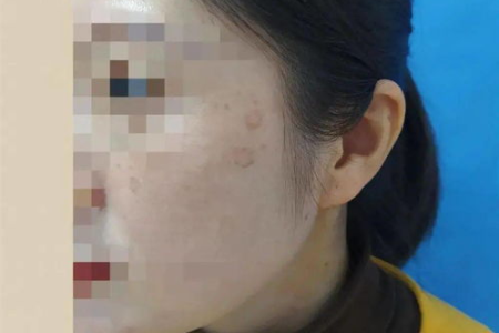 三十多岁手上长老年斑怎么办？皮肤性病科医生怎么说