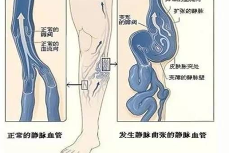 腿上静脉曲张外科手术：最快消除方法推荐