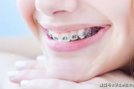 孩子几岁戴牙套矫正牙齿最好？最佳年龄及判断标准