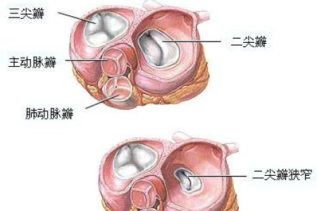 心血管内科：风湿性心脏病二尖瓣狭窄的治疗和护理要点