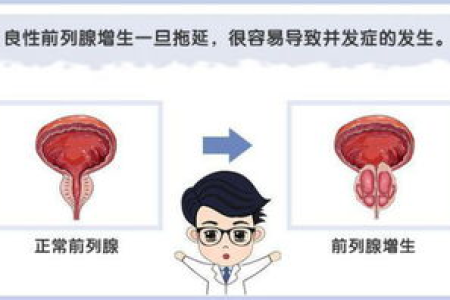 前列腺增生有什么症状？严重了会有什么危害？