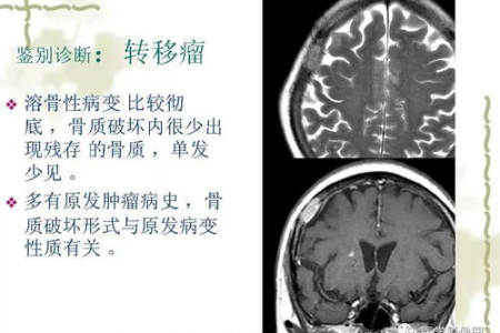 如何判断成人是否患有多动症？常见症状表现及鉴别诊断