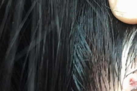 皮肤性病科：头上红疙瘩毛囊炎怎么快速治疗？