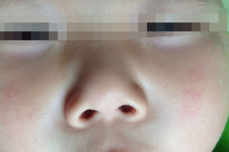 宝宝脸上红血丝怎么治疗效果好？皮肤性病科医生支招