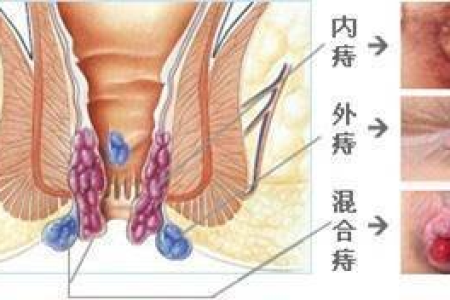 肛肠科外痔：摆脱疼痛的最快捷径