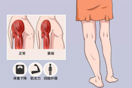 快速恢复骨科肌肉萎缩，这些方法你都知道吗？
