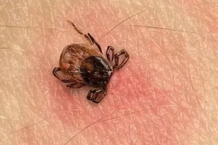 普外科医生讲解：蜱虫叮咬后的症状和治疗方案