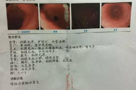 浅表性慢性萎缩性胃炎严重吗？中医养生能否缓解？