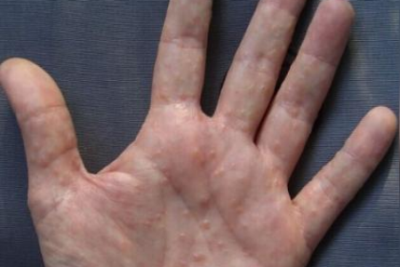 中医视角下的鹅掌风：病因、症状和治疗方法是什么？