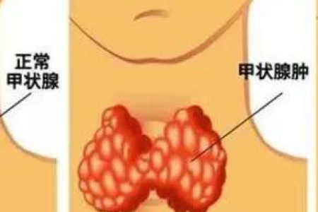 甲状腺结节4a类，中医养生如何有效治疗和预防？