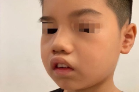 中医养生妙招：二岁宝宝腺样体肥大如何保守治疗？