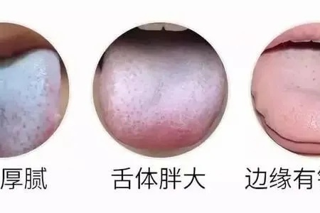 舌头白苔有齿痕，是脾胃出问题了吗？中医调理妙招！