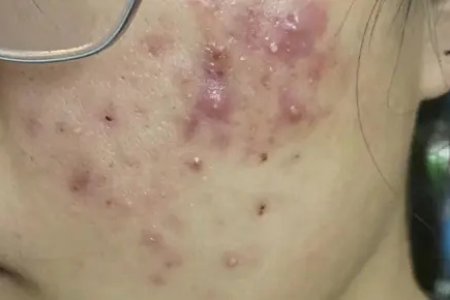 中医调理：去除痤疮后顽固皮下硬结
