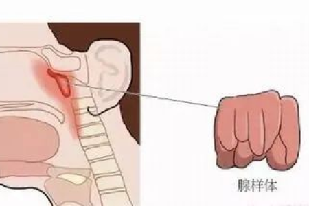 儿童腺样体肥大：中医养生调理，能改善症状吗？