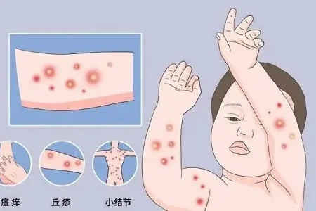 中医治疗痒疹的几种养生方法，有效缓解瘙痒症状