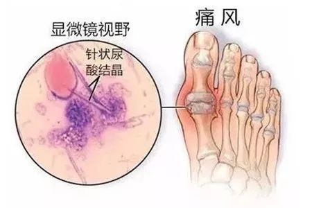 尿酸高？中医养生教你几招治疗高尿酸血症