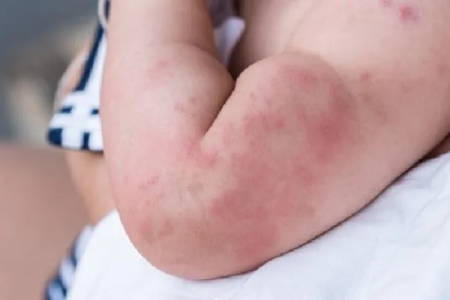 中医养生人群易患接触性皮炎？症状及中医调理方法