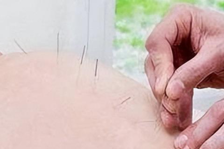 针灸减肥靠谱吗？中医养生针灸瘦身效果如何？