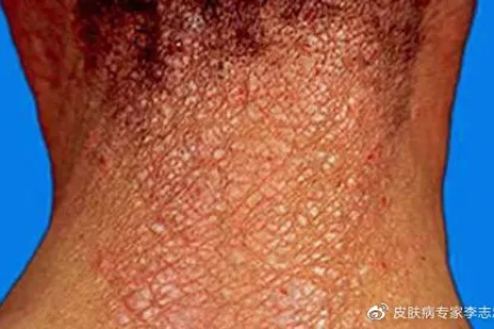 中医养生：神经性皮炎怎么治疗才能彻底根治？