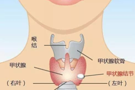女生的喉结突出是甲状腺结节吗？别慌，看看中医怎么说