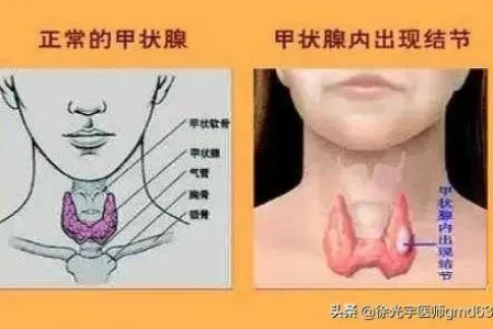 中医视角下的甲状腺结节是什么？如何通过养生改善？
