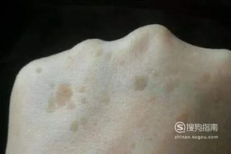 中医养生彻底根除扁平疣，方法技巧大公开